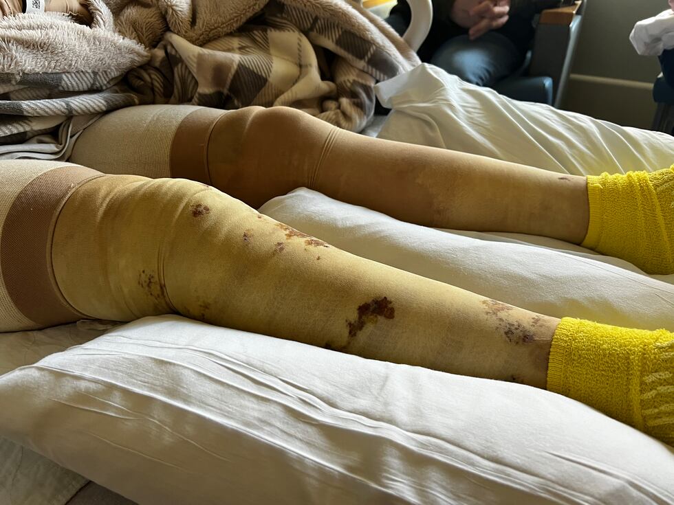 Accelerant Burn Woman suffers severe burns after friend pours accelerant on bonfire: ‘I ...